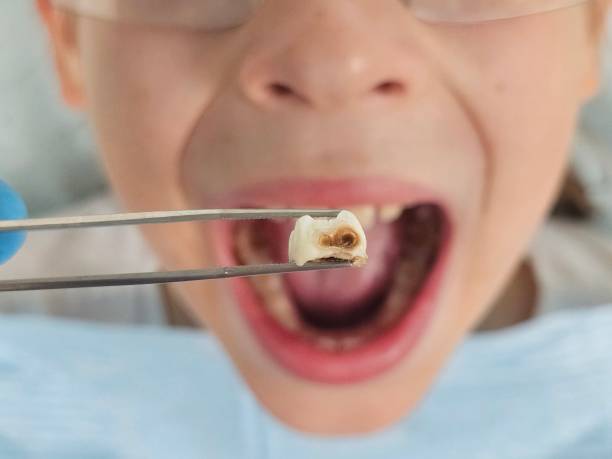 Best Cracked Tooth Emergency Dentist  in Parkwood, WA