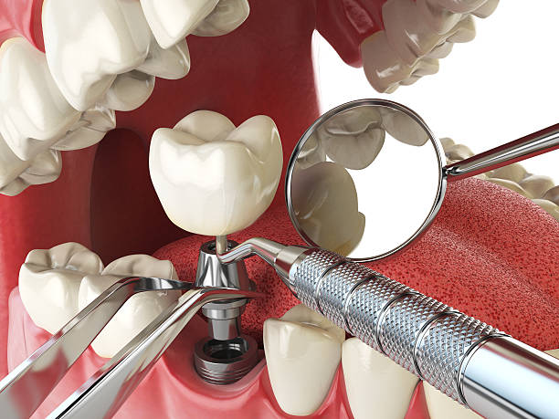 Best Dentist for Tooth Abscess  in Parkwood, WA